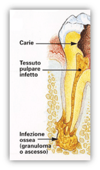 granuloma apicale